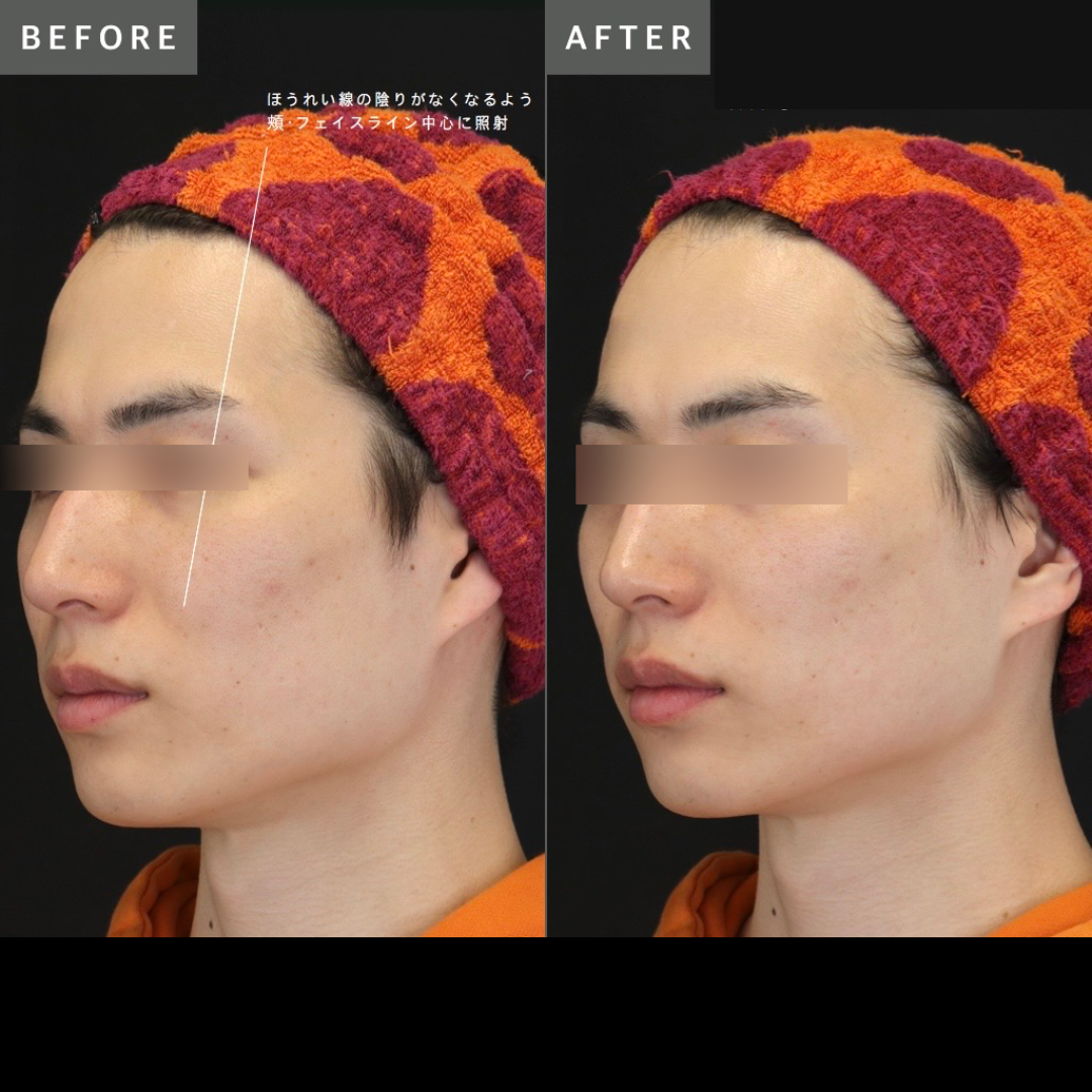 Before After