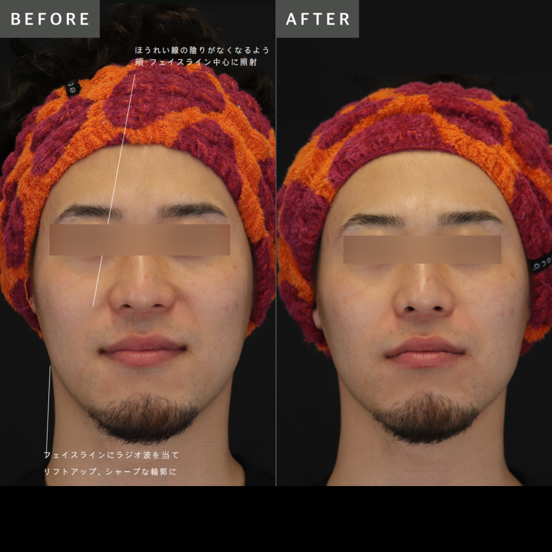 Before After