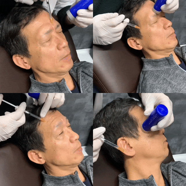 男性向けシワ取り注射