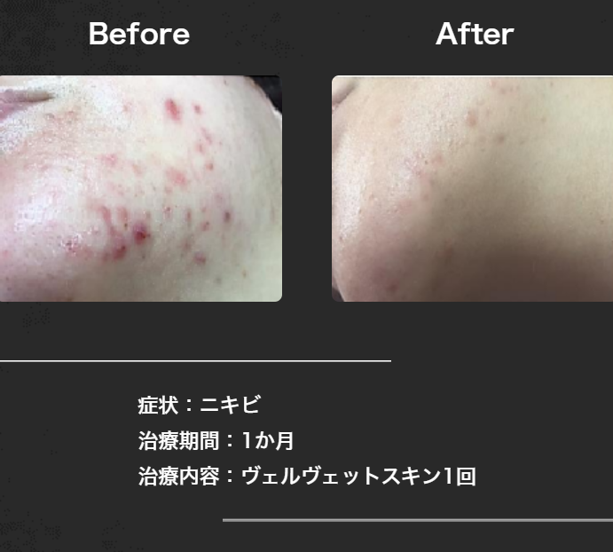 当院のダーマペン