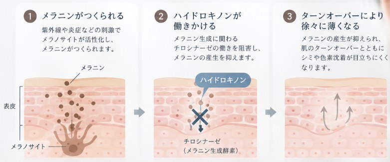 ハイドロキノンの作用のしくみ。紫外線や炎症でメラノサイトが活性化してメラニンがつくられ、ハイドロキノンがチロシナーゼのはたらきを妨げ、ターンオーバーとともに色素沈着が目立ちにくくなる3段階の図
