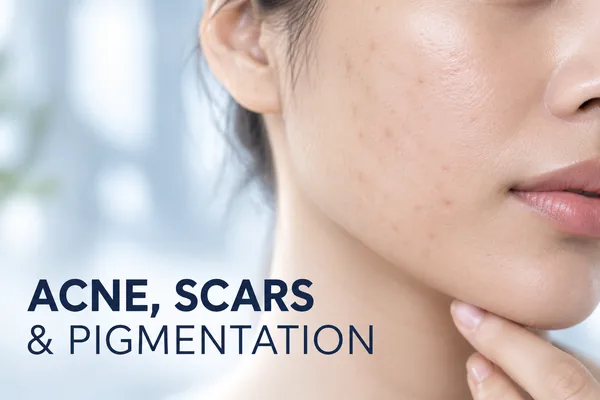 Acne, scars and pigmentation treatment