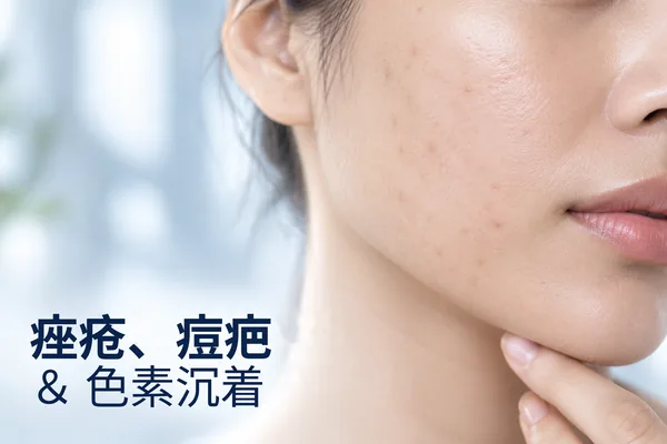 痘痘、痘坑与色素沉着