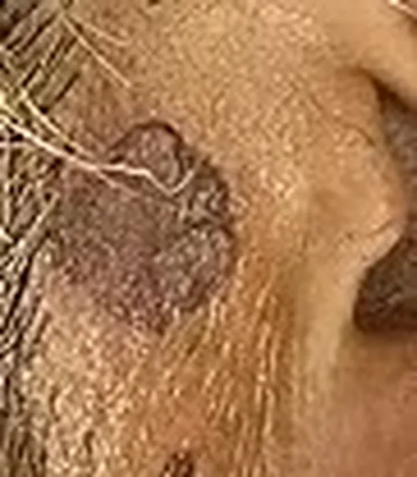 Case 2 before treatment: close-up of a dark brown spot in front of the ear