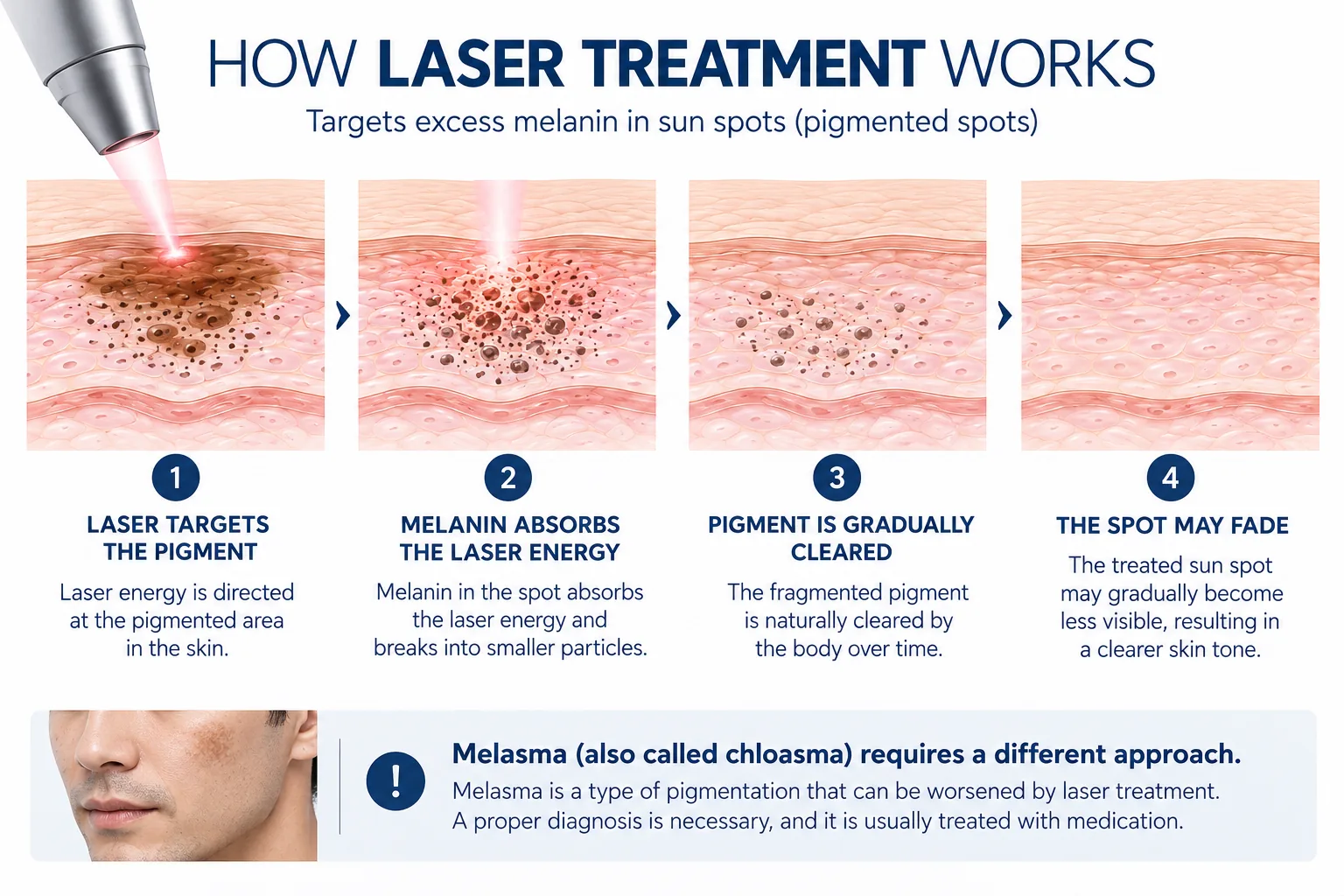 How laser treatment works. Targets excess melanin in sun spots (pigmented spots). 1, laser targets the pigment: laser energy is directed at the pigmented area in the skin. 2, melanin absorbs the laser energy: melanin in the spot absorbs the laser energy and breaks into smaller particles. 3, pigment is gradually cleared: the fragmented pigment is naturally cleared by the body over time. 4, the spot may fade: the treated sun spot may gradually become less visible, resulting in a clearer skin tone. Melasma, also called chloasma, requires a different approach. Melasma is a type of pigmentation that can be worsened by laser treatment. A proper diagnosis is necessary, and it is usually treated with medication.
