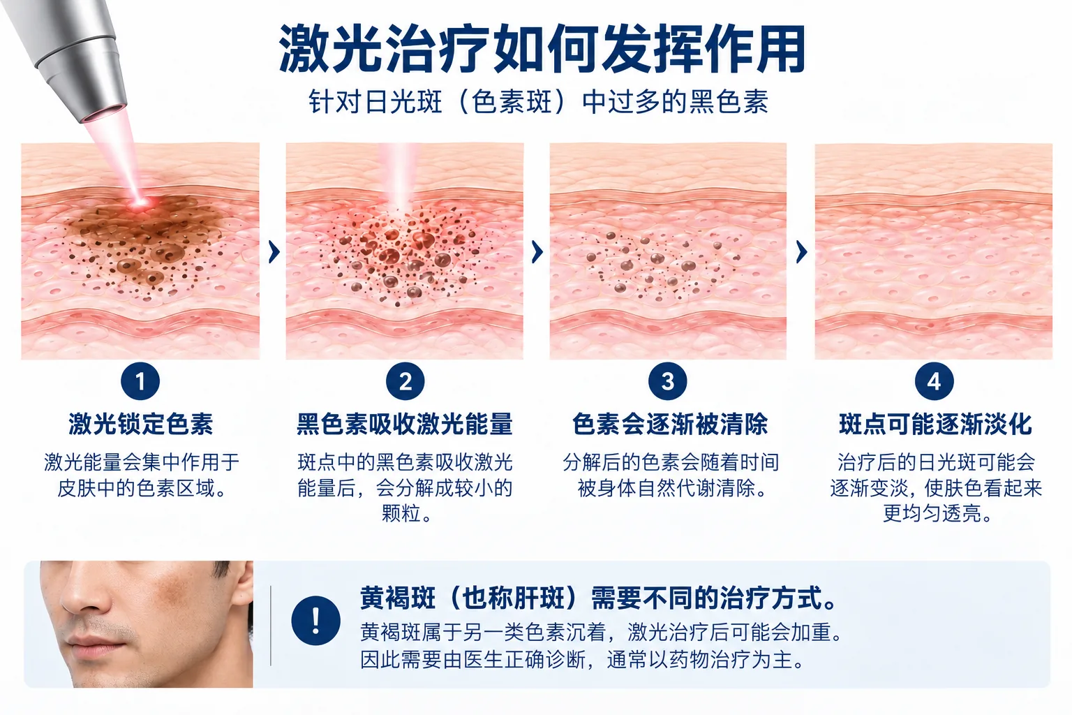 激光治疗如何发挥作用：针对日光斑（色素斑）中过多的黑色素。1 激光锁定色素：激光能量会集中作用于皮肤中的色素区域。2 黑色素吸收激光能量：斑点中的黑色素吸收激光能量后，会分解成较小的颗粒。3 色素会逐渐被清除：分解后的色素会随着时间被身体自然代谢清除。4 斑点可能逐渐淡化：治疗后的日光斑可能会逐渐变淡，使肤色看起来更均匀透亮。黄褐斑（也称肝斑）需要不同的治疗方式。黄褐斑属于另一类色素沉着，激光治疗后可能会加重。因此需要由医生正确诊断，通常以药物治疗为主。