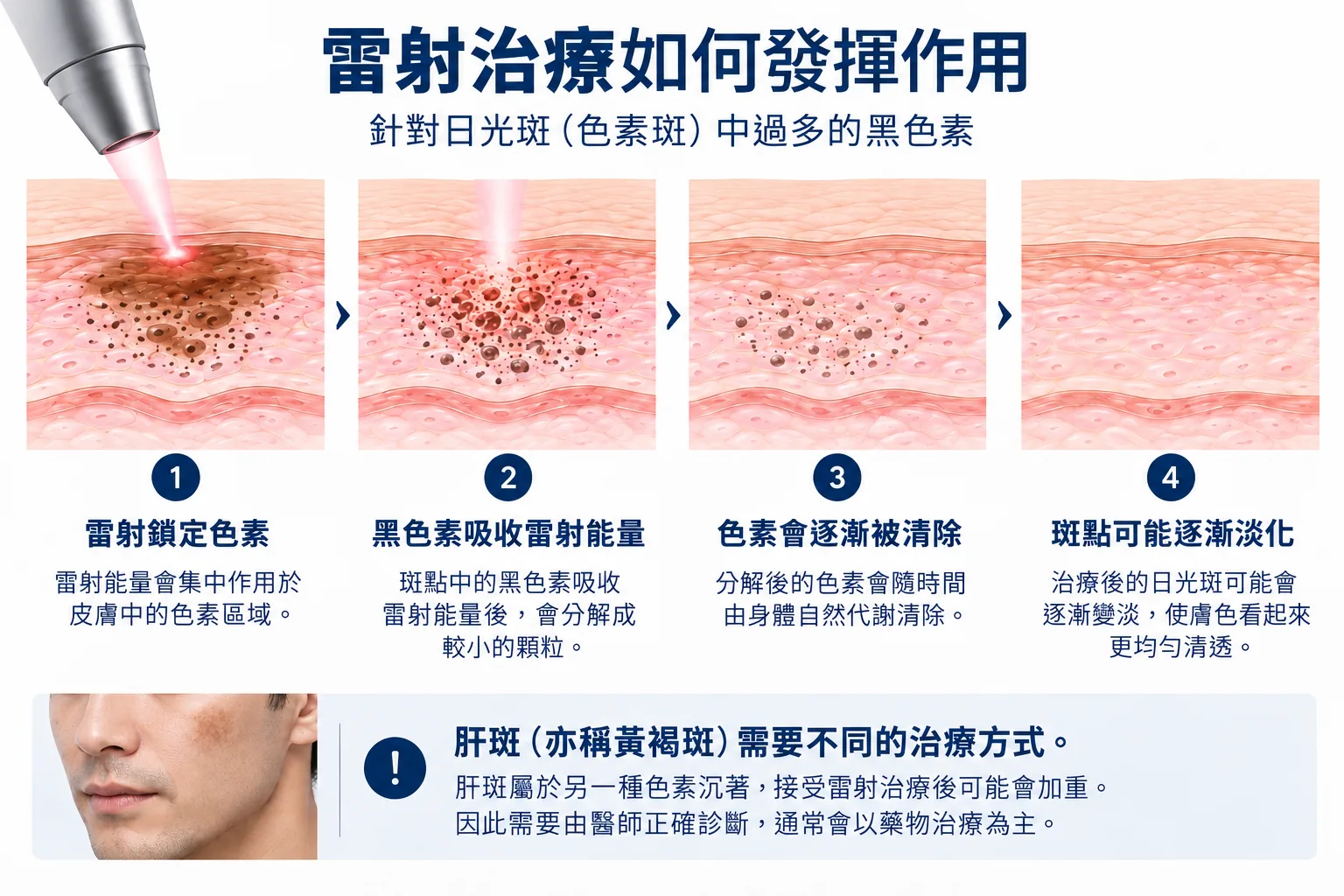 雷射治療如何發揮作用:針對日光斑(色素斑)中過多的黑色素。1 雷射鎖定色素:雷射能量會集中作用於皮膚中的色素區域。2 黑色素吸收雷射能量:斑點中的黑色素吸收雷射能量後,會分解成較小的顆粒。3 色素會逐漸被清除:分解後的色素會隨時間由身體自然代謝清除。4 斑點可能逐漸淡化:治療後的日光斑可能會逐漸變淡,使膚色看起來更均勻清透。肝斑(亦稱黃褐斑)需要不同的治療方式。肝斑屬於另一種色素沉著,接受雷射治療後可能會加重。因此需要由醫師正確診斷,通常會以藥物治療為主。