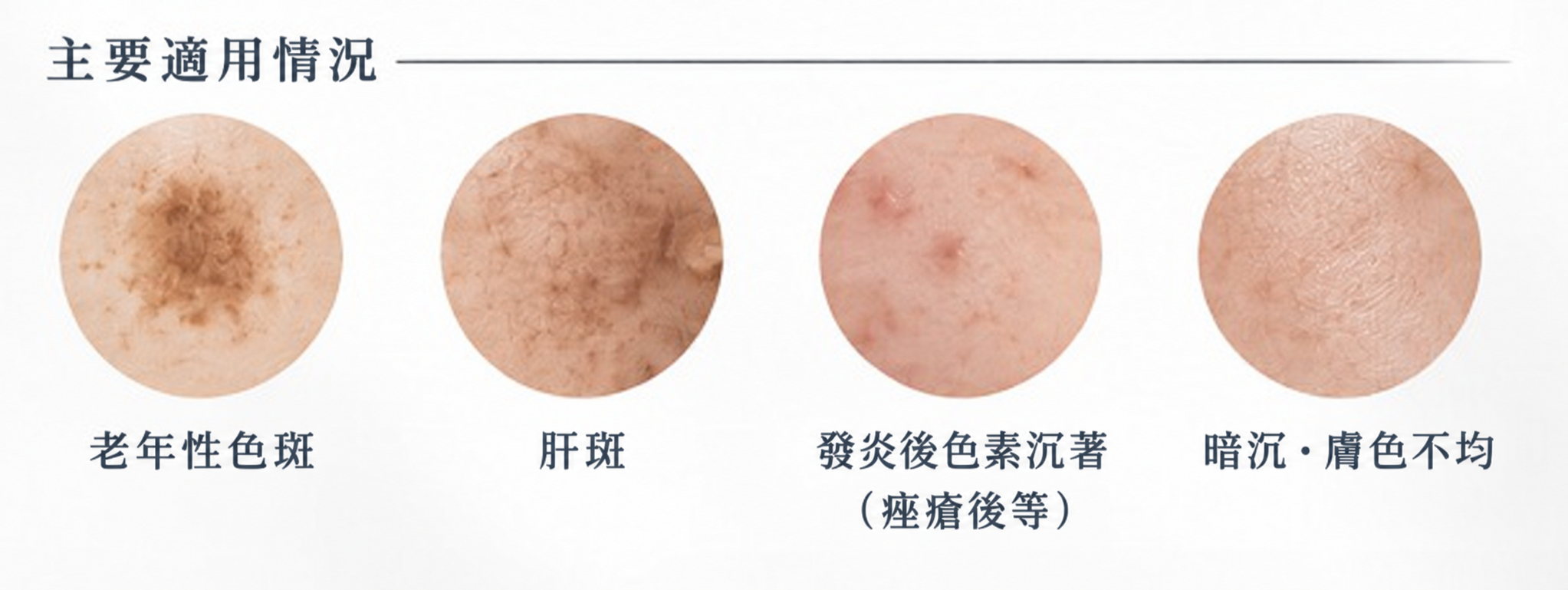 氫醌相關的四種情況:老年性色斑、黃褐斑、發炎後色素沉著、暗沉或膚色不均。是否適用需診察確認。